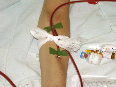 Ввод крови в руку при гемодиализе
